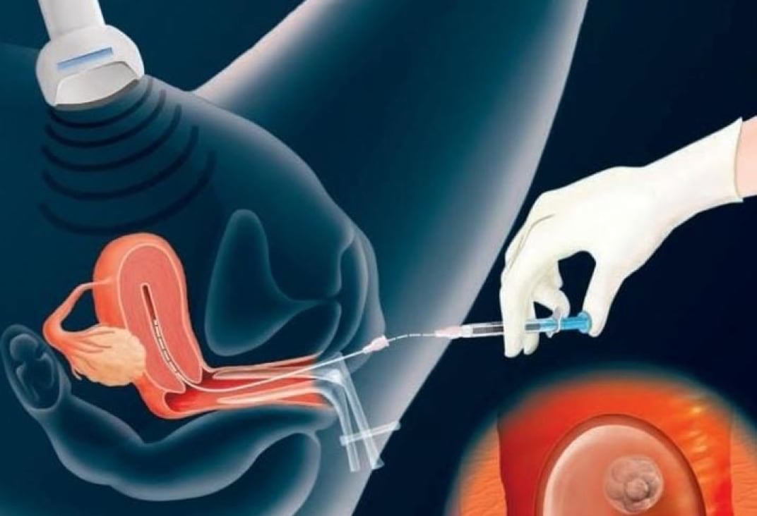Precautions After IVF Embryo Transfer
